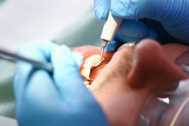 Best Emergency Dental Care for Broken or Chipped Teeth in Hoover, AL