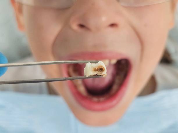 Best Urgent Care for Lost Fillings or Crowns in Hoover, AL